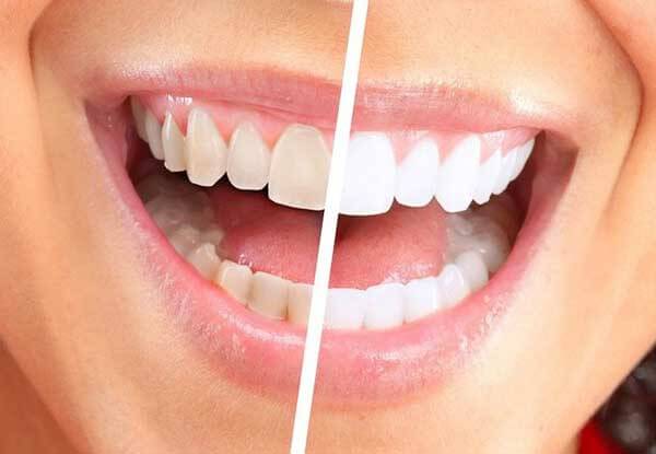 осветление зубов с помощью перекиси водорода